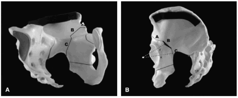 Acetabular Dysplasia Faqs Hip And Pelvis Doctor Articles Asia